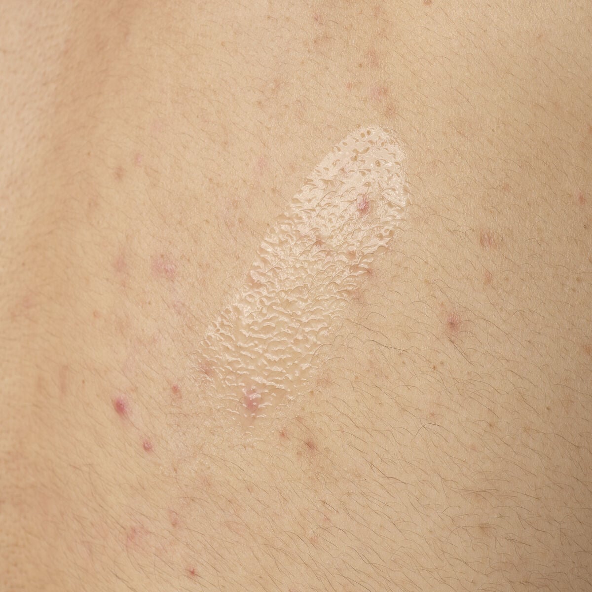 salicylic-acid-0-5-body-serum-l5 ORD-salicylic-acid-05-body-240ml-application.jpg