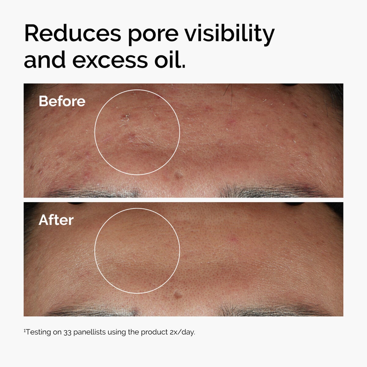 niacinamide-10-zinc-1-l8 ord-niacinamide-zinc-blemish-serum-before-after-pores.jpg