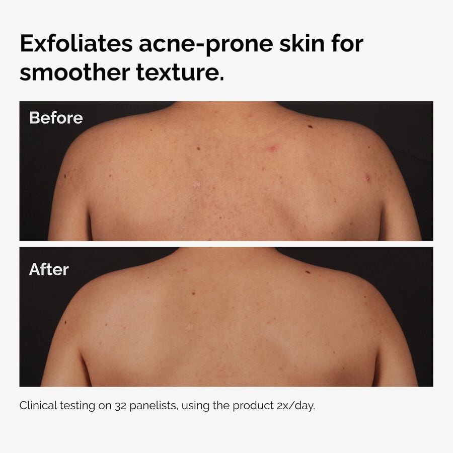 the-body-care-collection-t7 ord-salicylic-acid-body-serum-before-after-graphic-NA.jpg