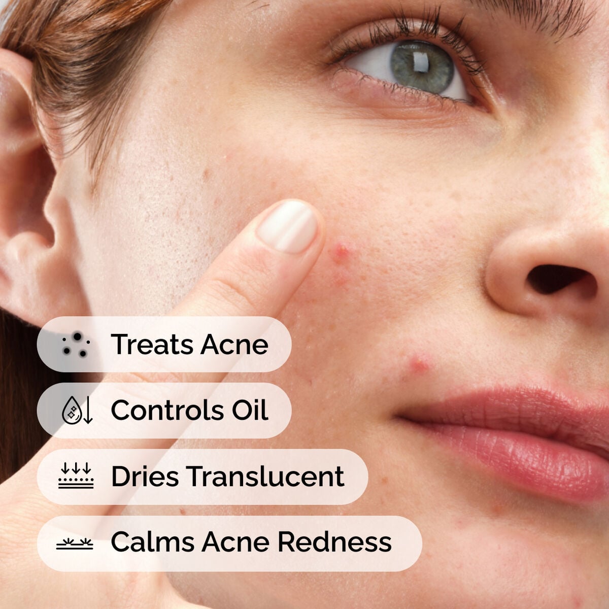 sulfur-10-powder-to-cream-concentrate-b2 ord-sulfur-10pct-powder-to-cream-concentrate-model-application-with-benefits-acne.jpg