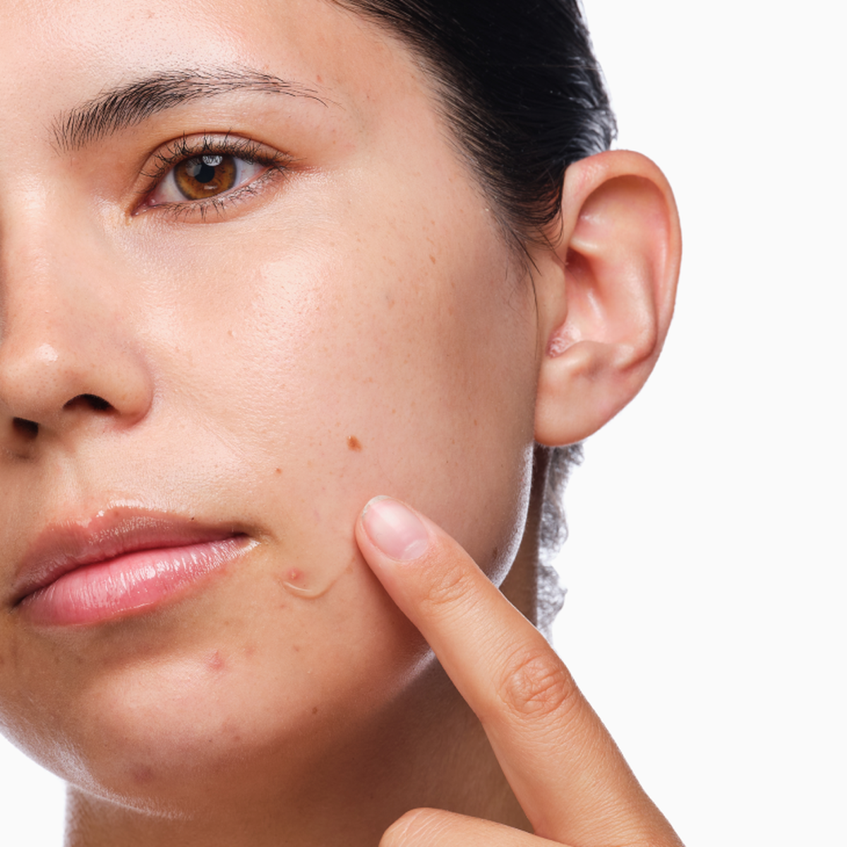 the-acne-set-h1 rdn-the-acne-set-application.png